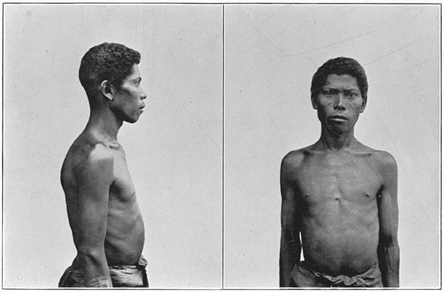 Negrito man of Zambales, (mixed blood).
