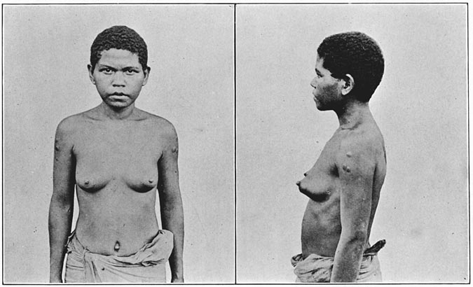 Negrito woman of Zambales, pure blood, showing scars made by blistering for fevers, etc.