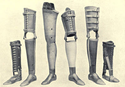 Various Types of Artificial Limbs
