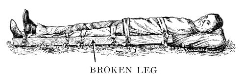 BROKEN LEG