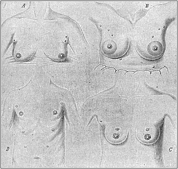 Fig.103, A, B. C, D. Instances of
redundant mammary glands and nipples (hypermastism).