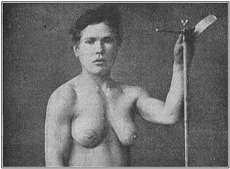 Fig.104. A Greek gynecomast.